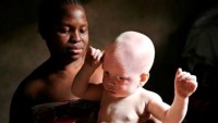 Albino Hastalarını Canlı Canlı Parçalayıp Satıyorlar