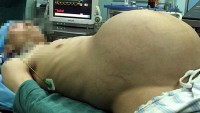Hamile Gibi Görünen Adamın Karnından 15 Kiloluk Tümör Çıktı