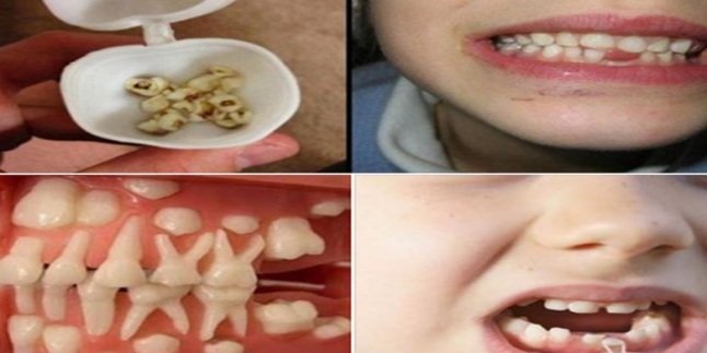 Çocuğunuzun Süt Dişlerini Asla Atmayın Neden mi! Bakın ne işe yarıyor